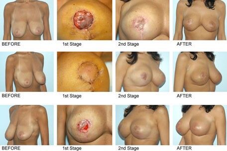 Free porn pics of Breast implant  bimbo 13 of 16 pics