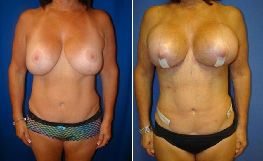 Free porn pics of Breast implant  bimbo 9 of 16 pics
